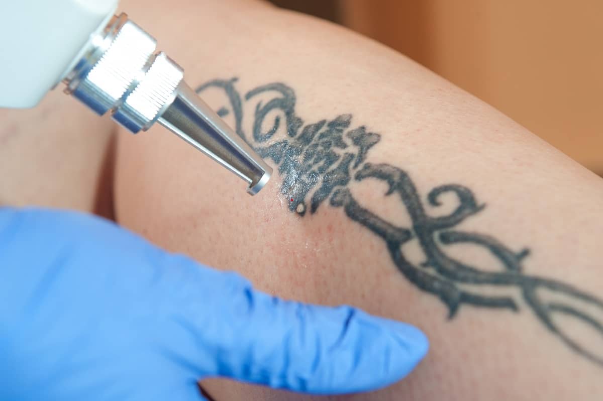 Laser Tattoo Removal in The Woodlands & Houston
