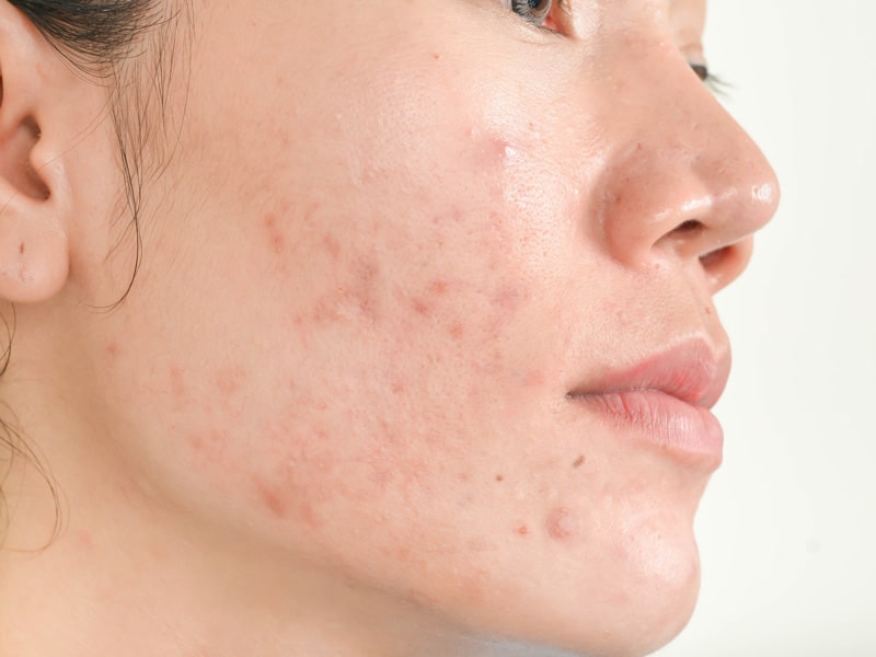 Say ‘So Long’ to Acne Scars