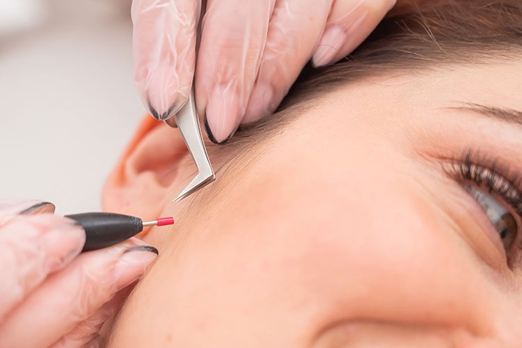 How long does electrolysis treatment last?