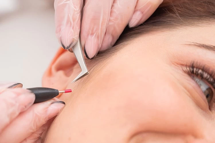 Electrolysis Hair Removal Treatment at Avante Laser & MediSpa