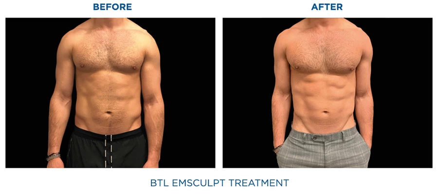 What is Emsculpt? Build Muscle and Sculpt Your Body - Blog