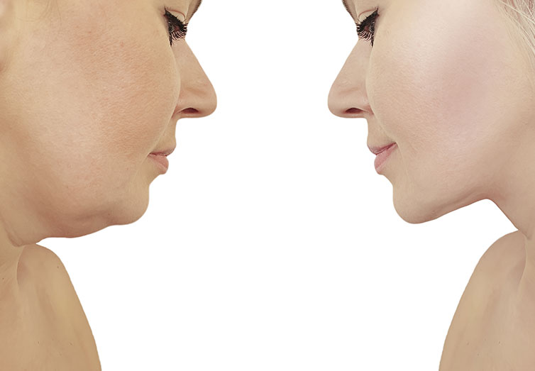 The Dreaded Double Chin: Causes & Solutions