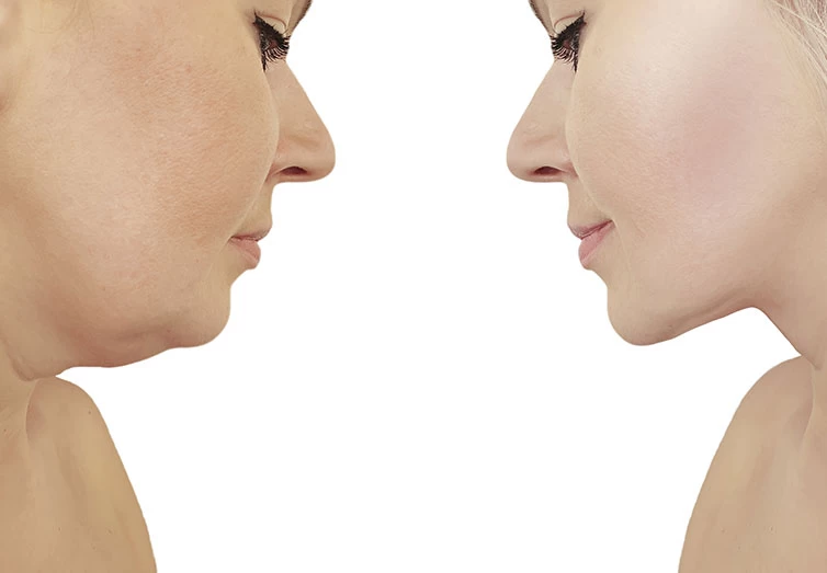 Beauty Med  Double Chin Removal: Face Sculpting with SculpSure