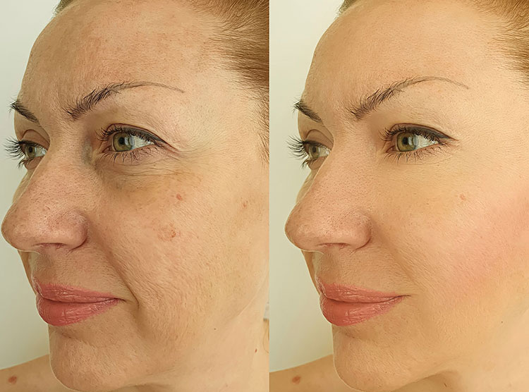 What is a PRP Facelift and PRP Facial?