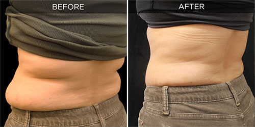 before/after