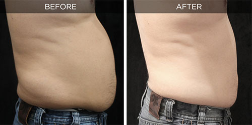 before/after