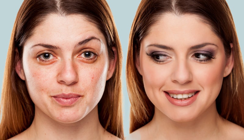 How does a dermal filler work?