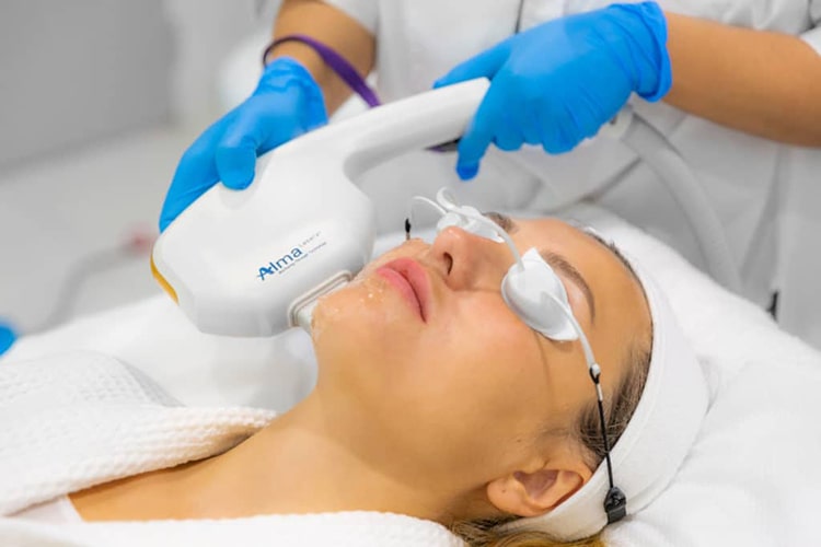 photofacials