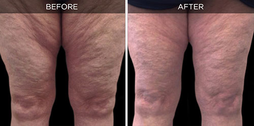 before/after
