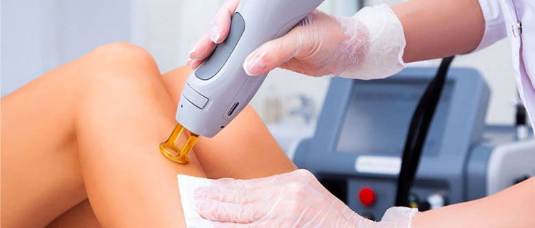 laserhairremoval