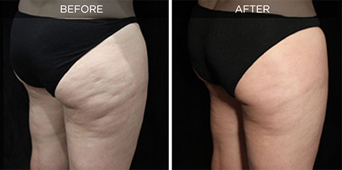 before/after