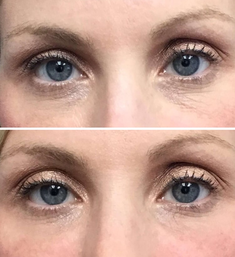 Average Cost of PRF Under Eye Treatment?