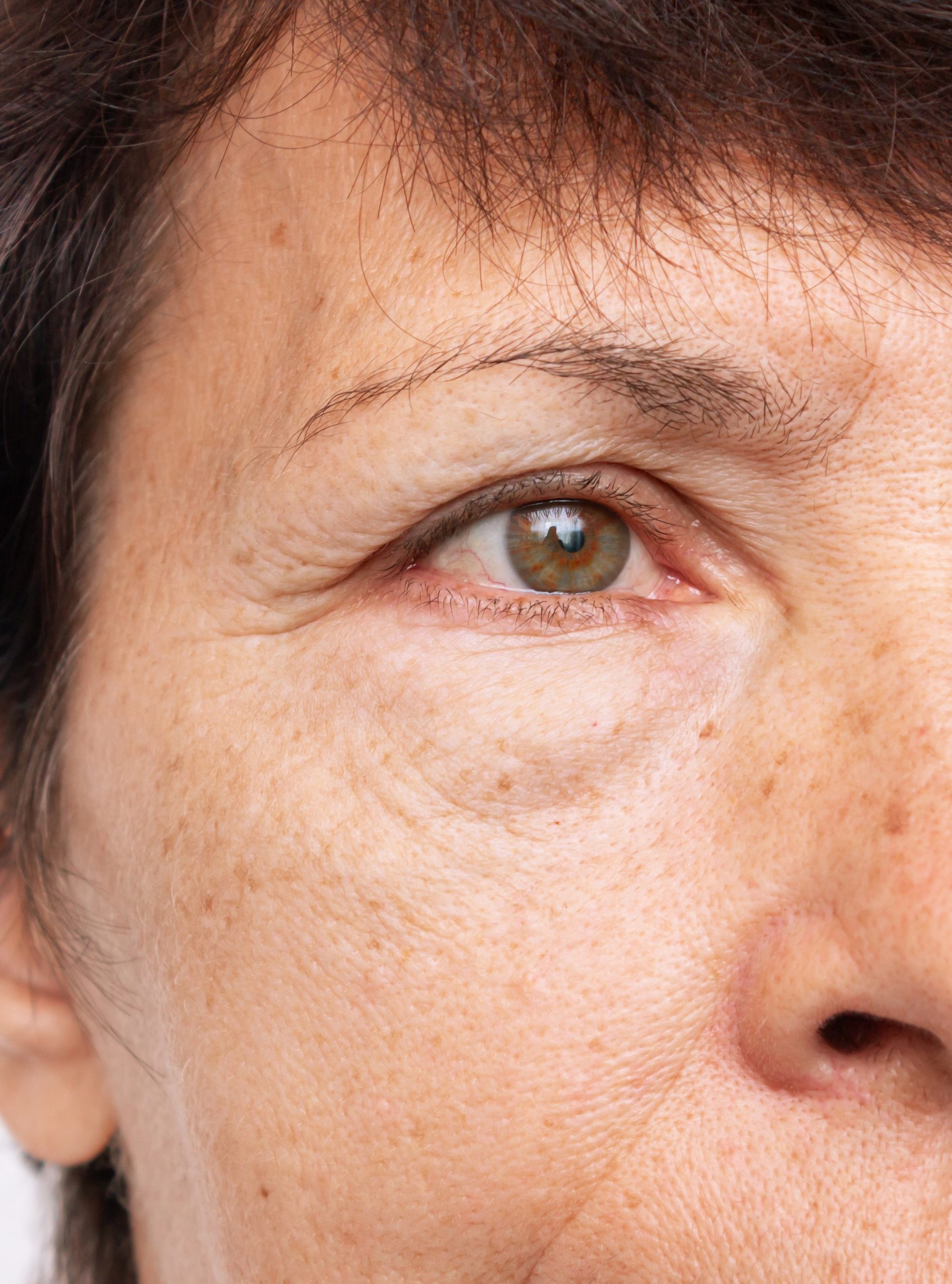 two-shots-elderly-woman-face-with-puffiness-her-eyes-wrinkles-before-after-treatment