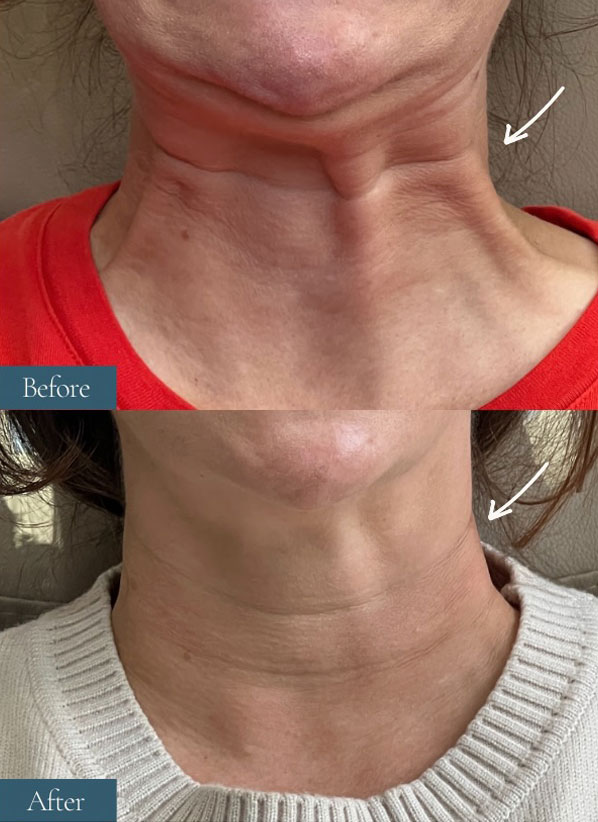 Avante patient before and after result
