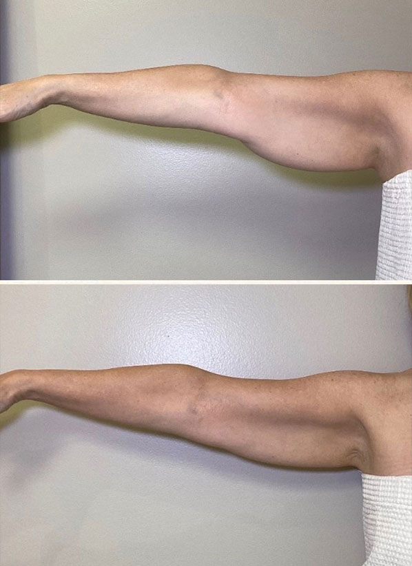 Avante patient before and after result