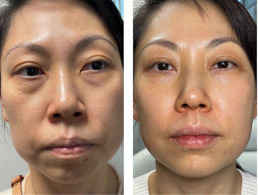 Avante patient before and after result