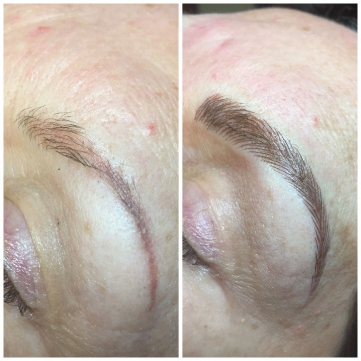Avante patient before and after result