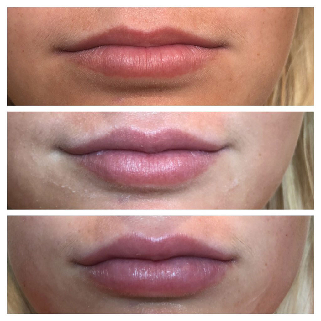Avante patient before and after result