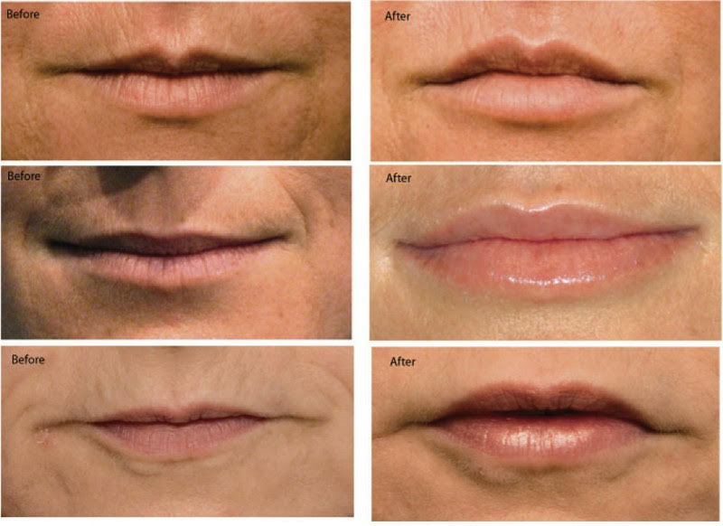 Avante patient before and after result
